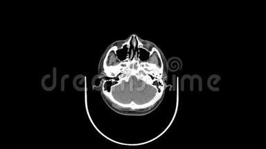 上颈顶视平滑运动CT扫描